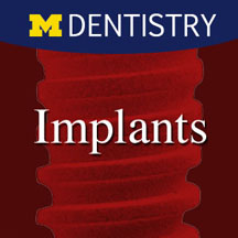 Implants - Single tooth